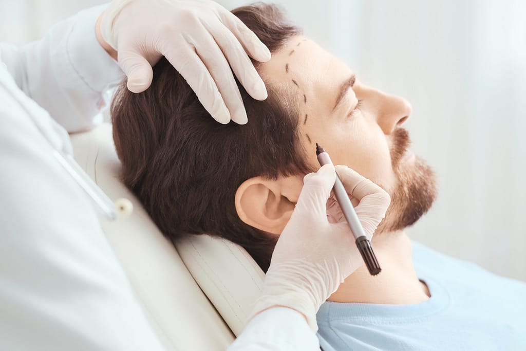 A medical specialist in green gloves using a marker to plan a male patient's new hairline for a hair transplant in Vietnam